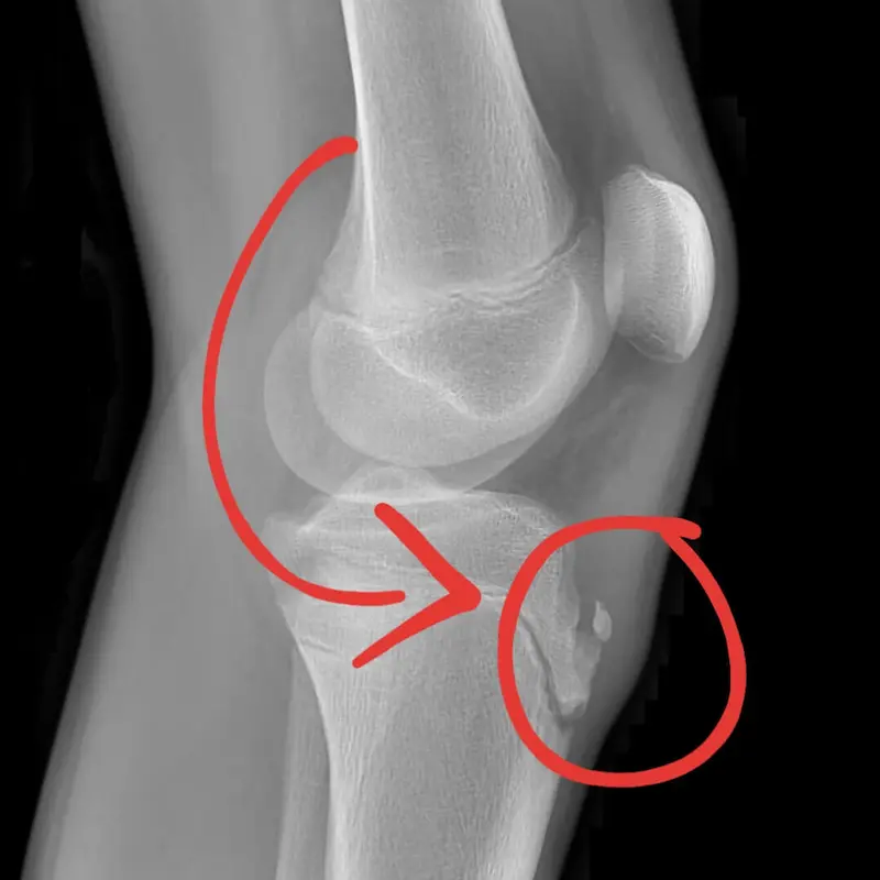 Tangram Health Osgood Schlatter Disease
